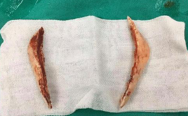 磨下頜角的時候會感受到疼痛嗎?