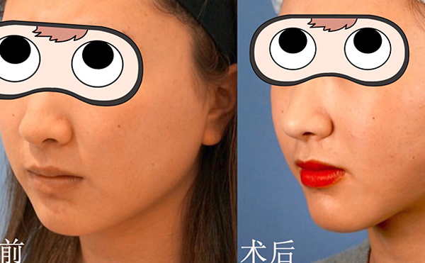 部吸脂有什么優(yōu)勢?術(shù)后臉下垂是怎么回事?