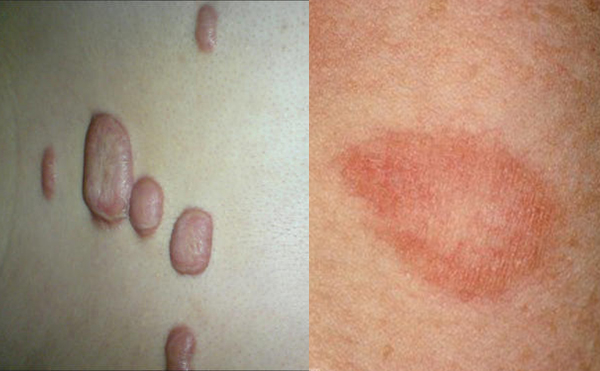 激光去頸紋有并發(fā)癥嗎？