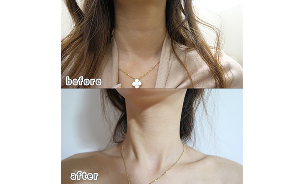 超聲刀去頸紋能維持多久？