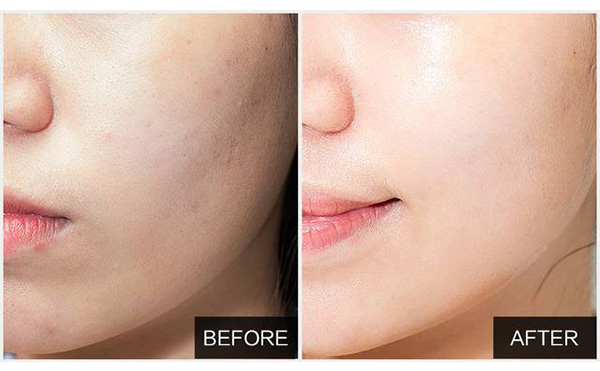 水光針能維持多久？