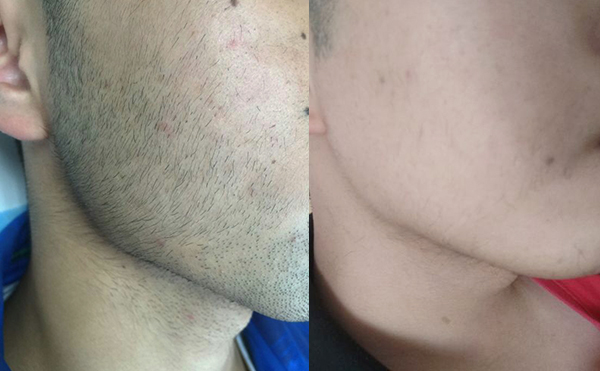 冰點面部脫毛效果怎么樣？