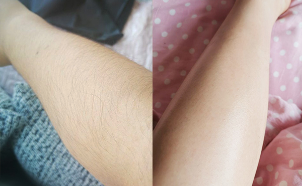 影響激光脫毛效果的因素有哪些？