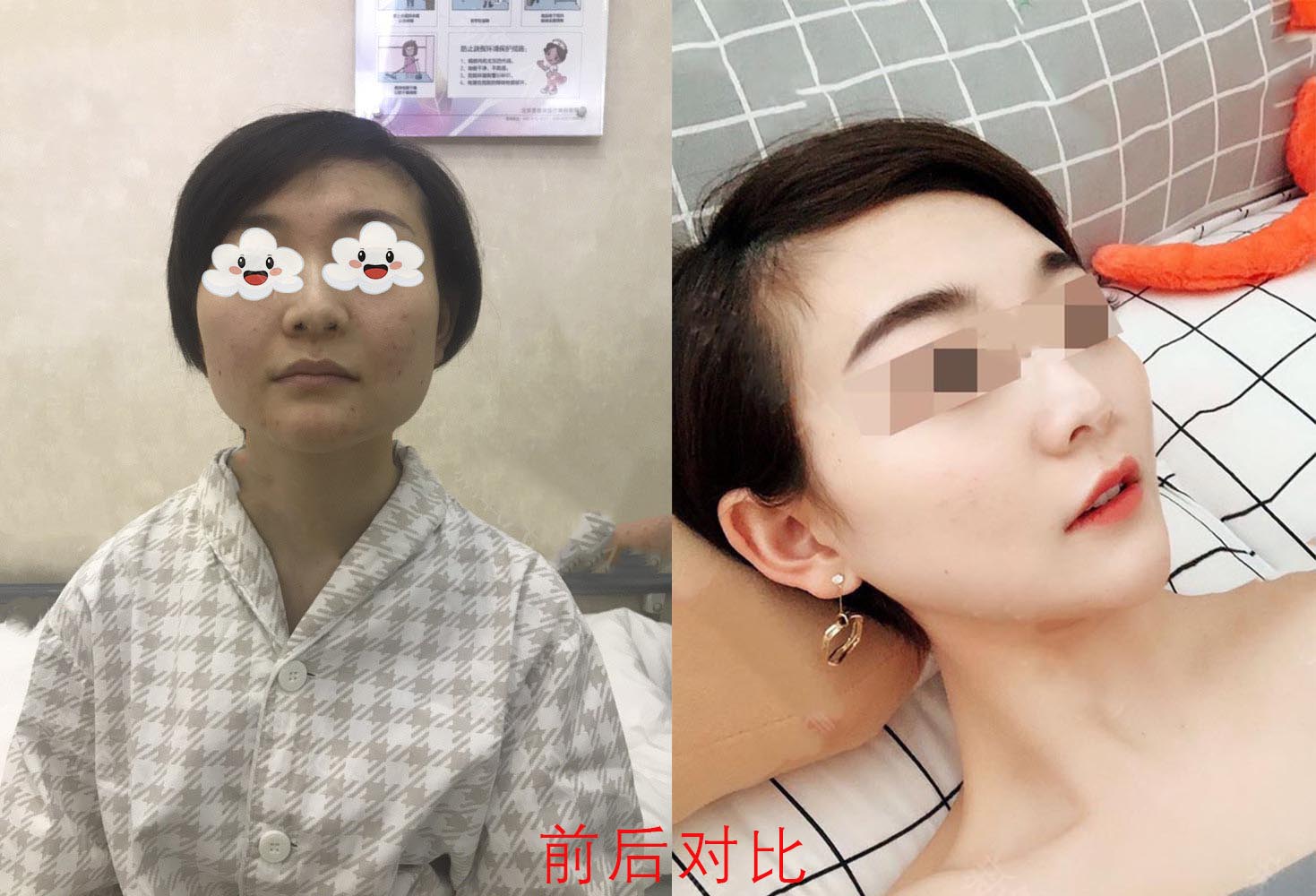 下頜角整形效果前后對比