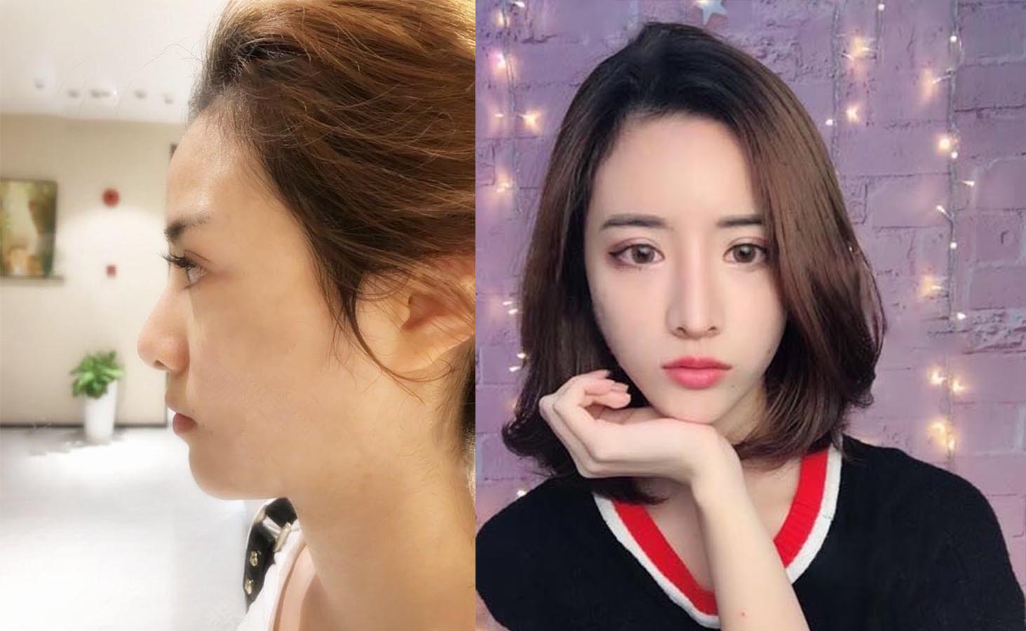 洛陽(yáng)醫(yī)生隆鼻效果