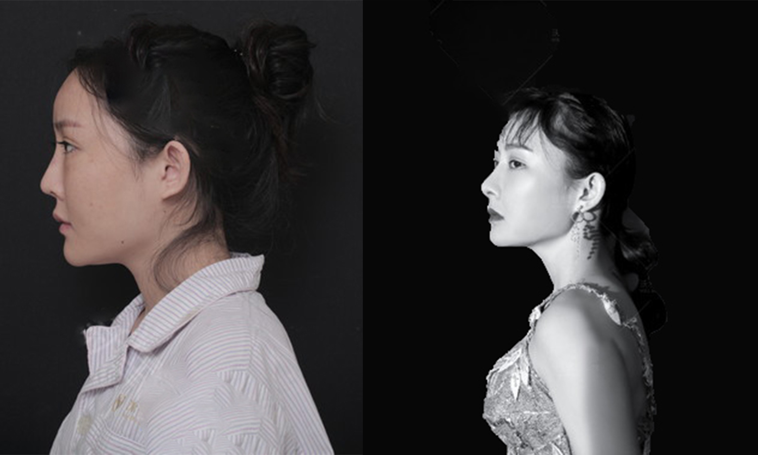 肋骨隆鼻手術(shù)效果圖