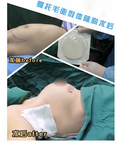 張紅栓醫(yī)生假體隆胸案例