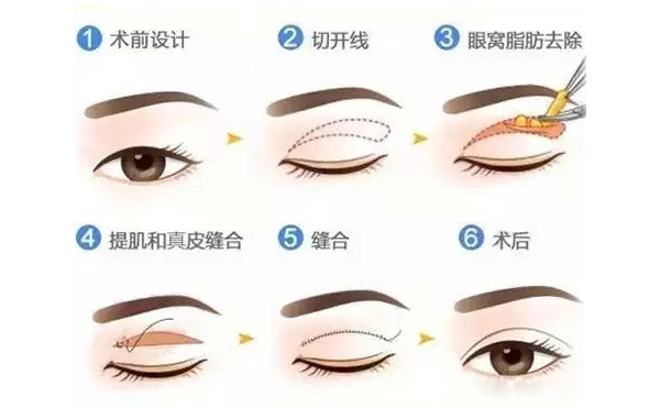 全切雙眼皮跟埋線(xiàn)的區(qū)別是什么？哪個(gè)好？