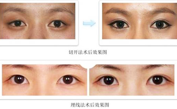 雙眼皮埋線和切開哪個比較好?疼痛程度有什么不同？