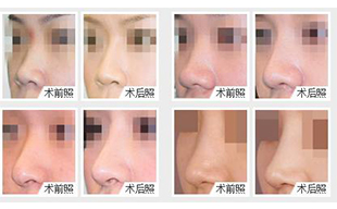 玻尿酸隆鼻好還是假體隆鼻好？更推薦哪一種？