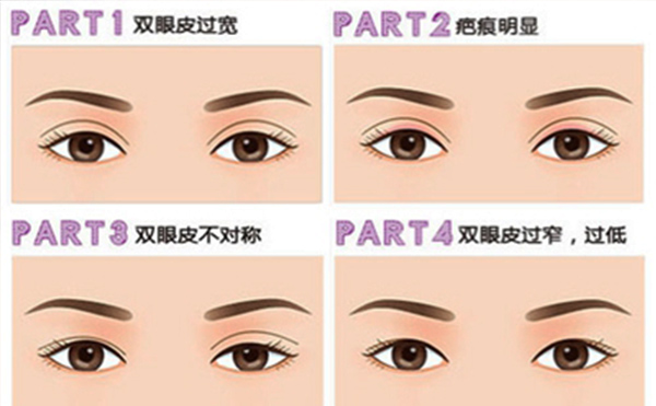雙眼皮失敗有哪些明顯表現(xiàn)？修復(fù)成功率大嗎？