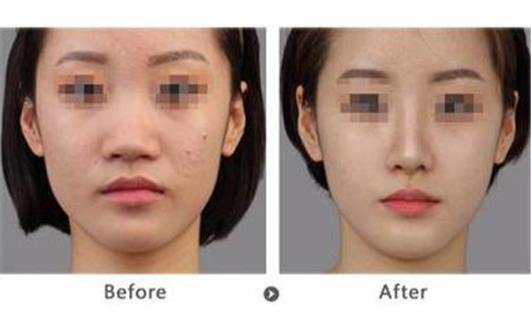 膨體隆鼻術(shù)后效果怎么樣？手術(shù)疼嗎？