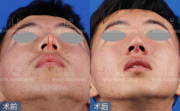 歪鼻修復術(shù)要多少錢？