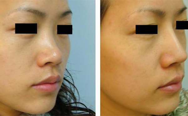 隆鼻手術(shù)有沒有什么后遺癥？