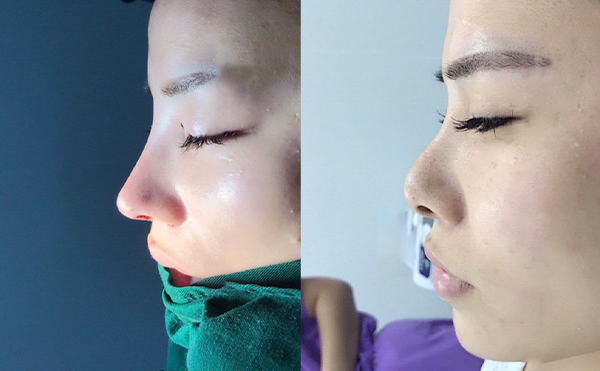 做隆鼻手術需要滿足什么條件？月經期間可以做隆鼻手術嗎？
