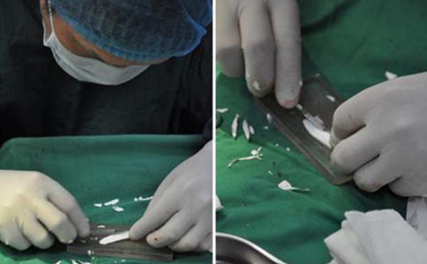 做隆鼻手術(shù)疼不疼？