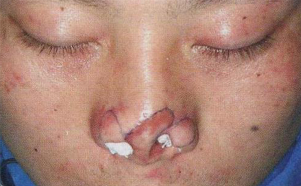 鼻翼缺損矯正效果自然嗎