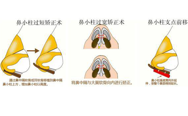 鼻小柱缺損修復(fù)有幾種方法？為什么會出現(xiàn)鼻小柱缺損的情況