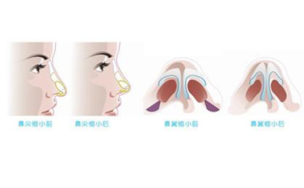 鼻翼縮小整形安全嗎？術(shù)后會不會影響呼吸