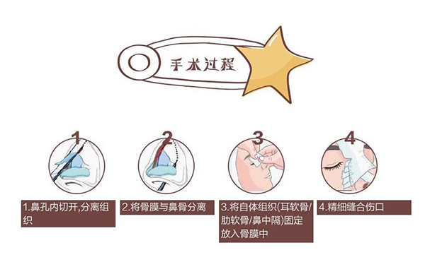 自體軟骨隆鼻為什么這么受歡迎？