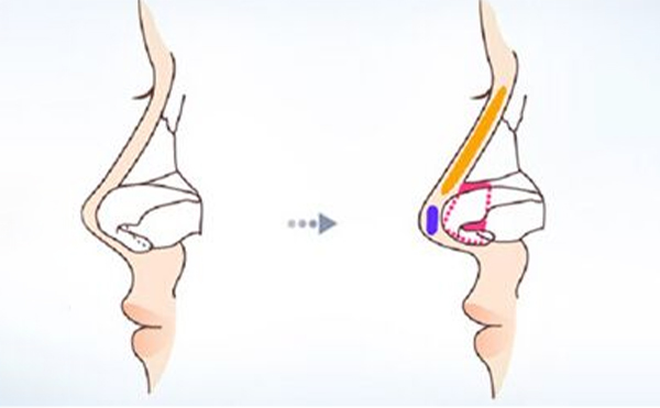 鼻小柱在什么情況下會影響美觀?鼻小柱的各種畸形是如何矯正的