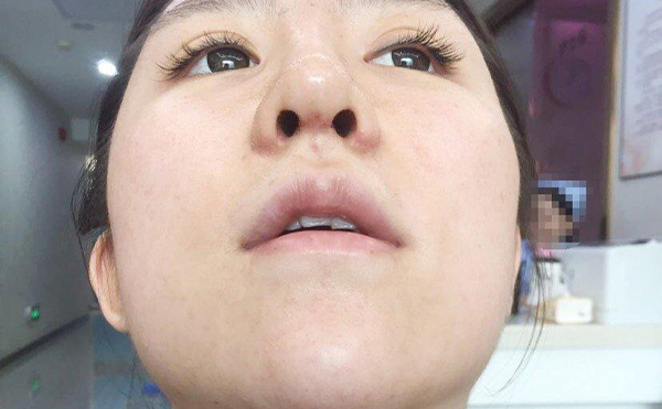 有沒有不做手術(shù)讓鼻孔縮小的方法?捏鼻子有用嗎?