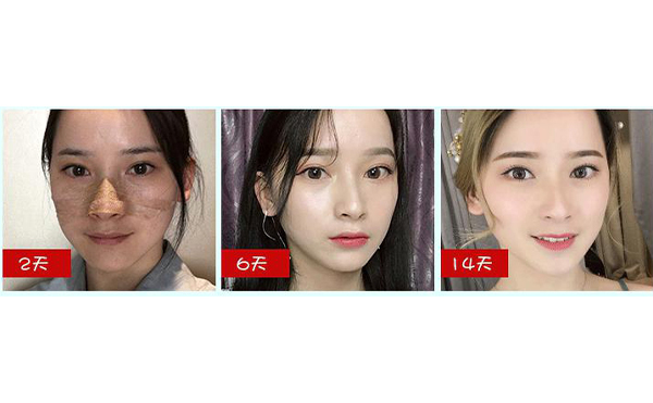 全肋鼻和半肋鼻有什么區(qū)別？做全肋好還是半肋好