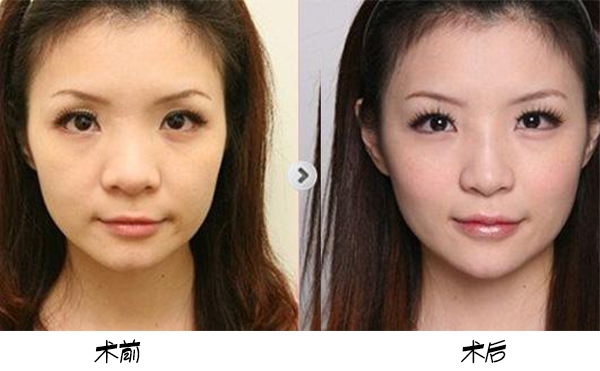 為保證鼻頭肥大矯正手術(shù)效果，術(shù)前術(shù)后應(yīng)該注意些什么？