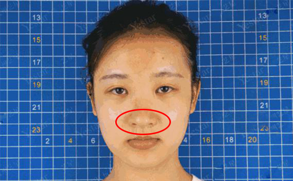 鼻頭肥大是什么原因造成的？怎么解決鼻頭肥大