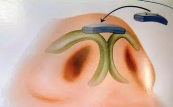 鼻小柱缺損修復(fù)手術(shù)有風(fēng)險嗎?術(shù)前注意事項有哪些?
