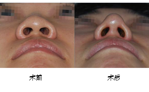 鼻小柱延長手術(shù)的大致流程是什么？手術(shù)成功率高嗎