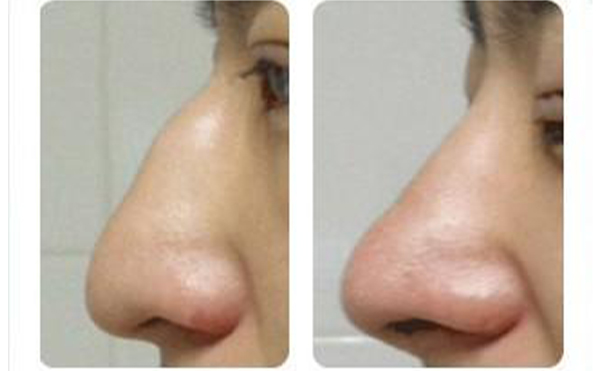 駝峰鼻矯正有哪些方法？