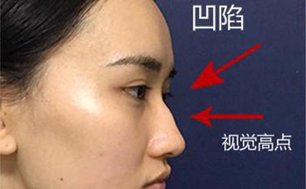 駝峰鼻整形是怎么做的？不同嚴(yán)重程度的駝峰鼻矯正方法一樣嗎？