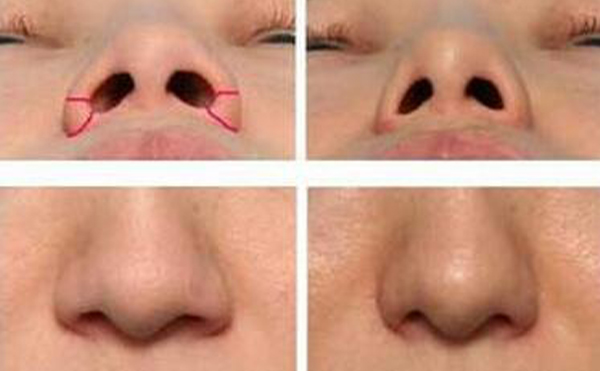 哪些人適合做鼻孔縮?。恳话銜檬裁捶椒▉磉_(dá)到縮小鼻孔的目的