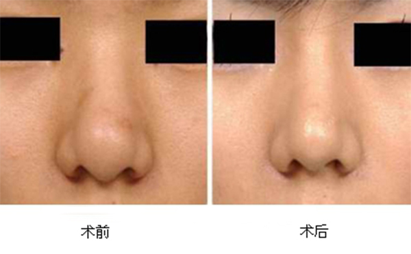 縮小鼻頭有什么辦法?為什么說一定要選擇正規(guī)醫(yī)院醫(yī)生做手術(shù)