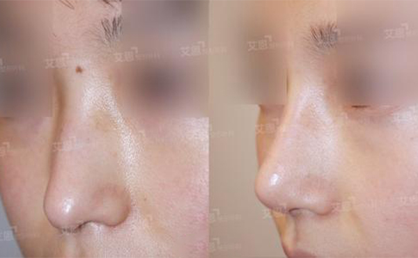 長(zhǎng)鼻是畸形鼻嗎?鼻子過(guò)長(zhǎng)的矯正方法是什么?