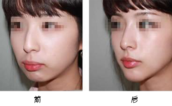 箭鼻是怎么出現(xiàn)的?箭鼻矯正是如何操作的？