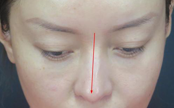 歪鼻矯正術(shù)效果怎么樣?術(shù)后需要注意哪些方面?
