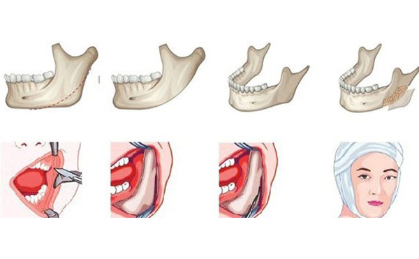 哪些人不能做下頜角切除手術(shù)？