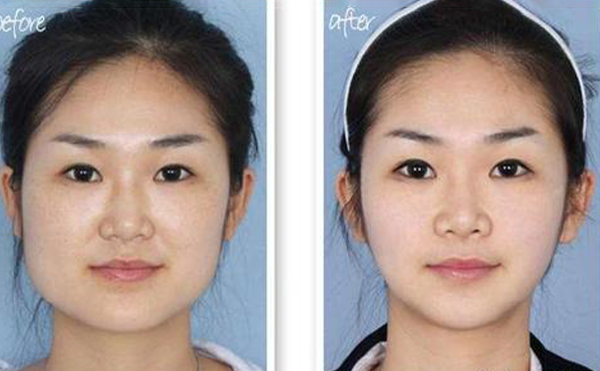 下頜整形術后護理