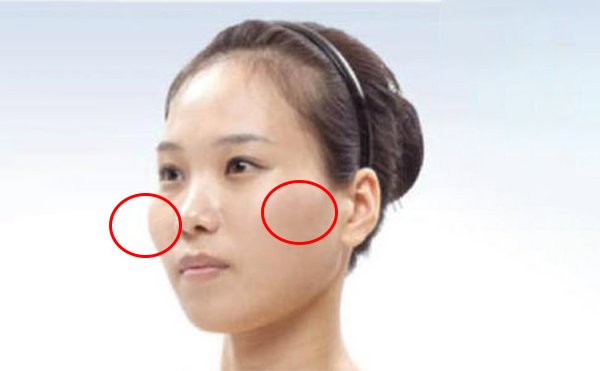 一般顴骨整形手術(shù)選擇哪個(gè)切口?