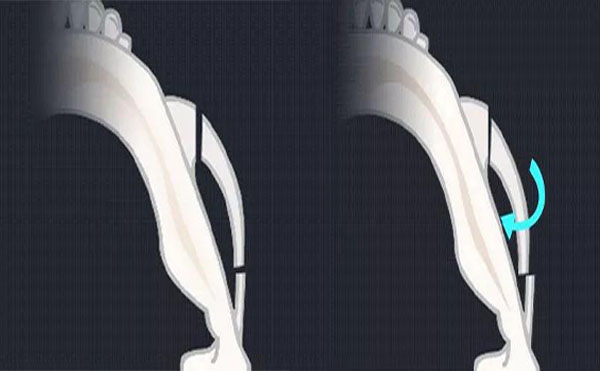 顴骨內(nèi)推是什么？