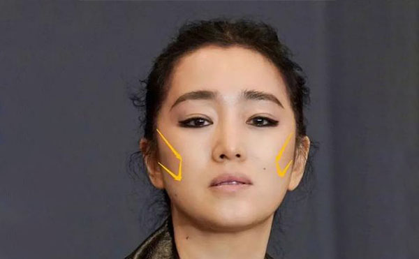 什么原因?qū)е嘛E骨外擴？