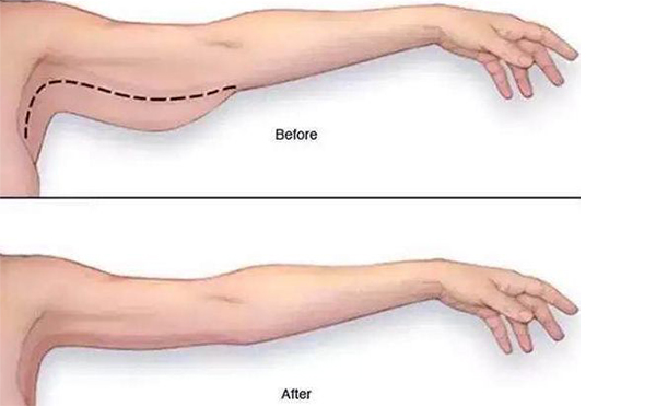 手臂吸脂需要多長時(shí)間恢復(fù)？
