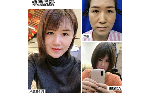 電波拉皮除皺的步驟是什么？