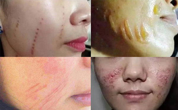 超聲刀有副作用嗎？