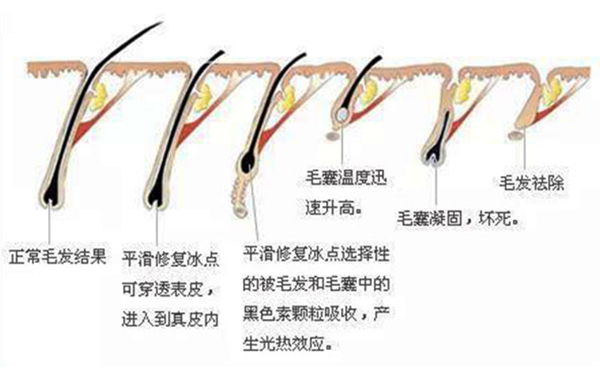 面部冰點脫毛會反彈嗎?不到半年又長了是怎么回事?