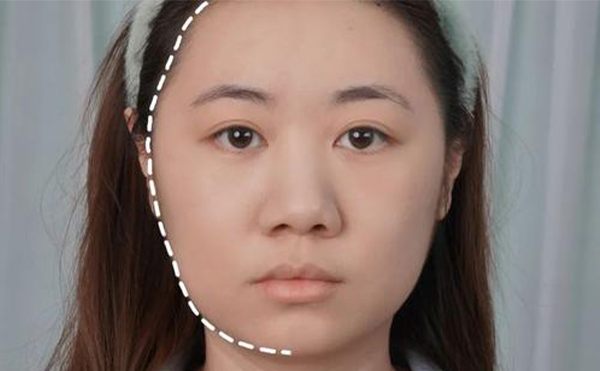 大臉改小臉整形怎么做？