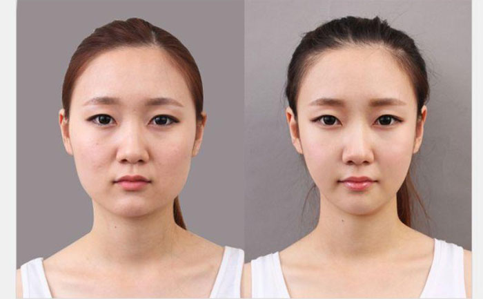 非手術(shù)瘦臉多少錢(qián)？非手術(shù)瘦臉?lè)椒ㄓ心男? data-mce-src=