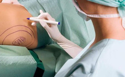 無痛吸脂是怎么做的？無痛吸脂手術價格是多少？